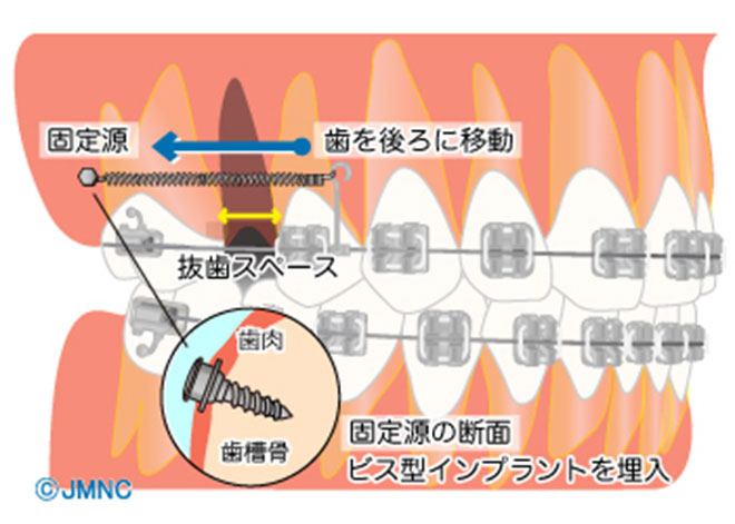 歯科矯正用アンカースクリュー